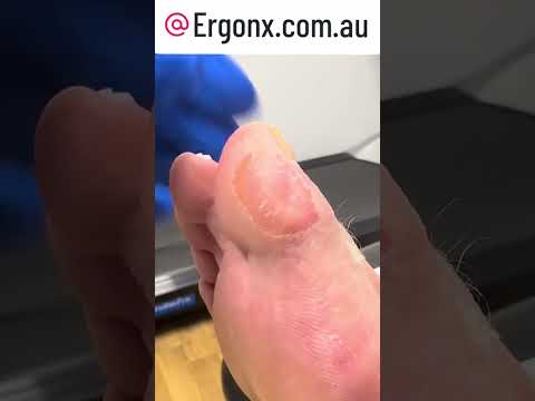 How to Manage Big Toe Calluses from Work Boots