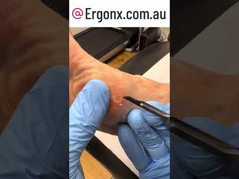 Shocking Callus Removal Reveals Unexpected Foot Wart #Podiatry #FootCare