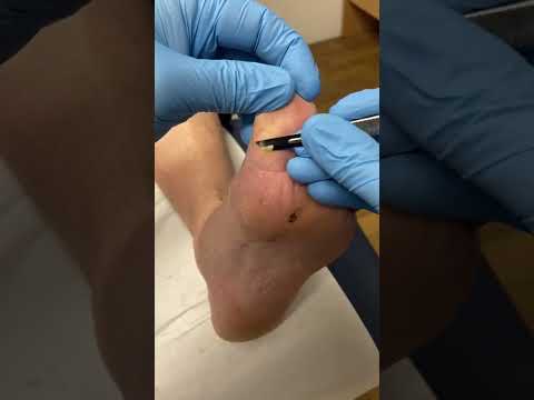 Transform your feet and say goodbye to that tough skin! Watch as we unveil the secret to smooth,