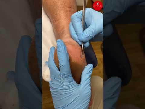 Transform your feet from rough to soft with this ultimate heel callus removal hack! 🚿✨ Watch as