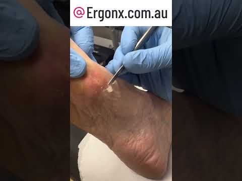 Ultimate Callus Removal by Expert Podiatrist in Australia #FootCare #Podiatry