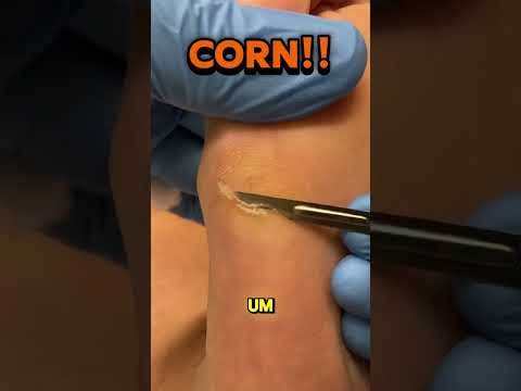 Hard corn and callus under the 5th metatarsal head? This one can be particularly tender because it