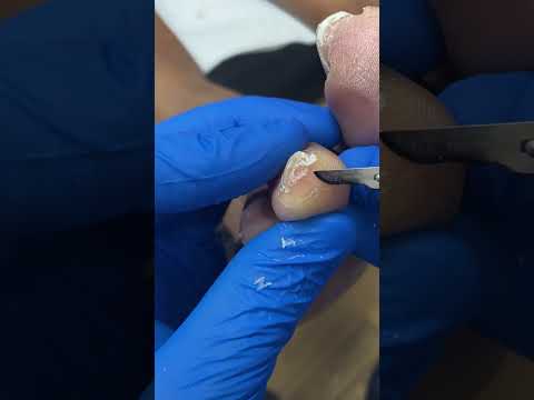 Satisfying Callus Removal by Podiatrist - Watch the Transformation! #Callus #FootCare