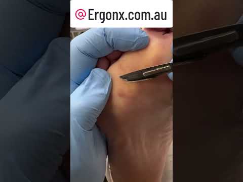 Ultimate Callus Removal from Scar in Podiatry Clinic #Podiatry #FootCare
