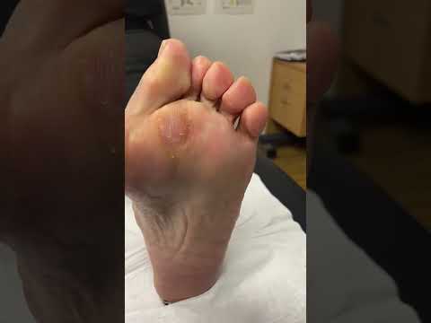 Watch this oddly satisfying podiatrist session as they work their magic on a thick forefoot callus!