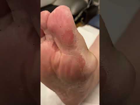 Say goodbye to stubborn toe calluses!✨ Check out this satisfying transformation as we tackle the