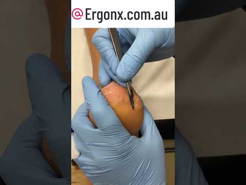 Ultimate Heel Transformation Satisfying Callus Cutting #Satisfying #Skincare