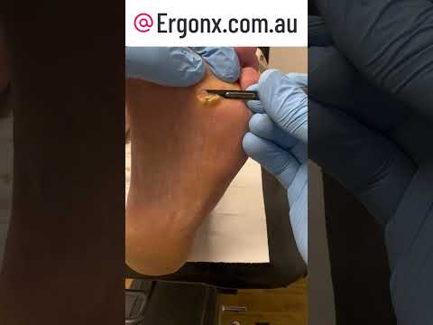 Amazing Foot Transformation Corn and Callus Removal for RA Relief #FootCare #RA