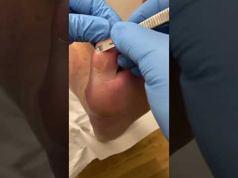Watch this satisfying big toe callus transformation! 🦶✨ Swipe to see the expert scalpel techniques