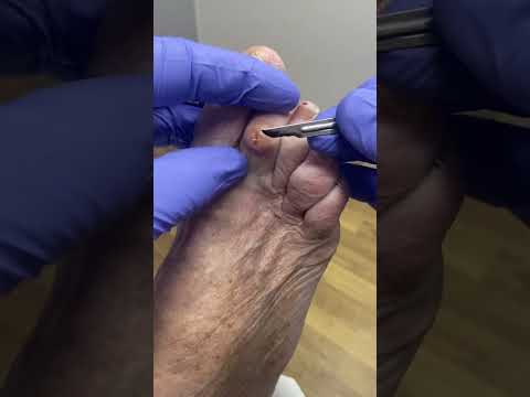 Watch as a skilled podiatrist expertly removes a corn from the 2nd toe! 👣 Say goodbye to discomfort