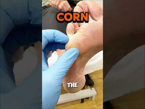 When you see a painful corn under the little toe joint (the 5th metatarsal head), it’s usually not