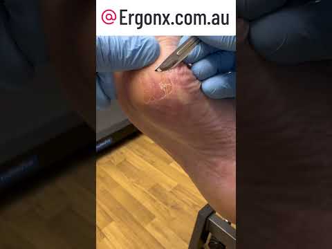 Ultimate Callus Crack Fix Unveiled Podiatry Clinic's Expert Guide #Podiatry #FootCare
