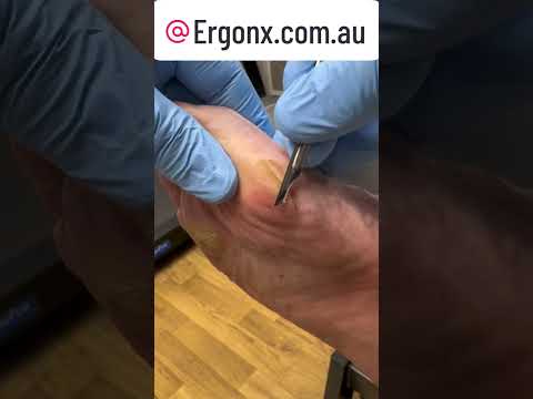 Extreme Foot Transformation Satisfying Callus Removal by Podiatrist #FootCare #CallusRemoval