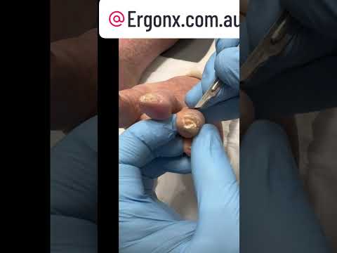 Satisfying Thick Skin Removal from Toe Podiatrist's Expert Care #FootCare #Satisfying