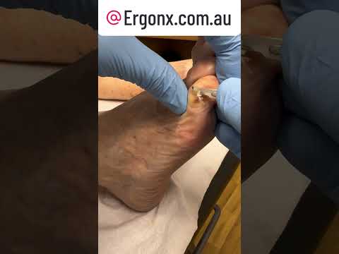 Satisfying Foot Care: Little Toe Callus Removal by Podiatrist #FootCare #Podiatrist #CallusRemoval