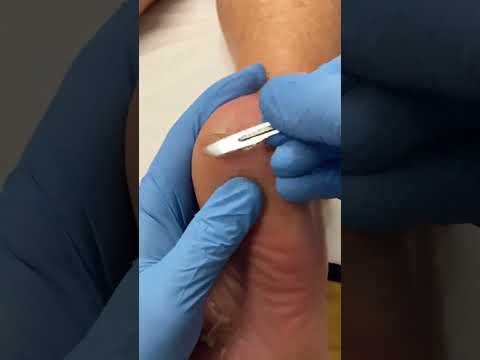 Transform your feet with this ultimate callus removal hack! Say goodbye to thick heels and hello to