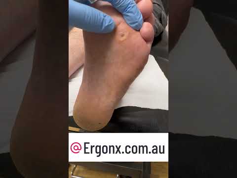 Ultimate Foot Corn Cutting Satisfaction ASMR #Podiatry #FootCare