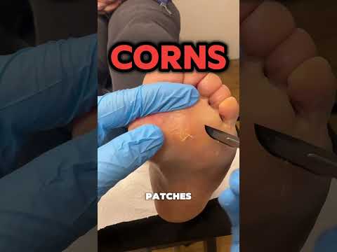 Painful Plantar Corns & Calluses Removed One of the most common reasons people come into the