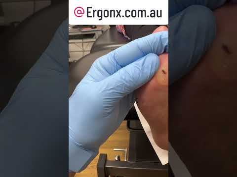 Say Goodbye to Painful Corns & Calluses Foot Transformation by a Podiatrist #FootCare #Podiatry