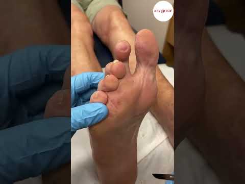 How a Ball-of-Foot Callus Is Carefully Reduced