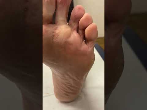 "Watch this satisfying transformation as a podiatrist works magic on pesky corns! 🦶✨ Ready for