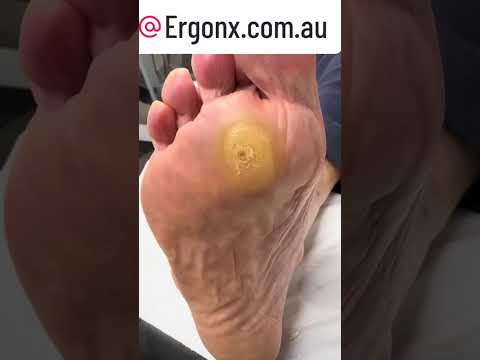 Ultimate Forefoot Corn & Callus Removal by Podiatrist #Skincare #FootCare