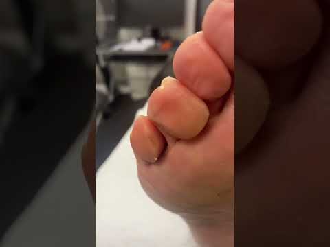👣 Watch this satisfying pinch callus removal by a pro podiatrist! Transform your feet from rough to