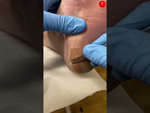 Professional Heel Callus Removal Explained: New Video Guide