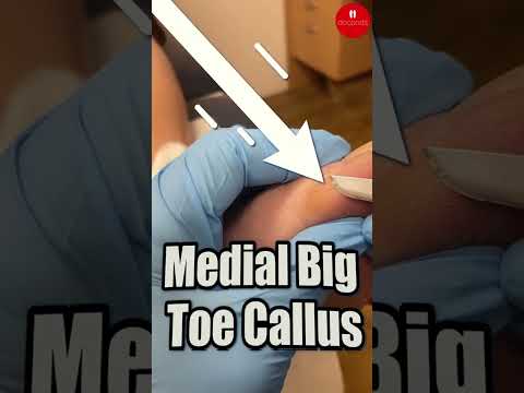 Transforming hard skin on my big toe! 👣✨ Watch me achieve smooth, callus-free feet! #FootCare