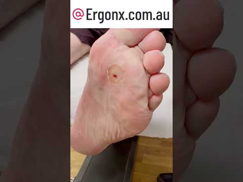 Oddly Satisfying Corn Removal from Feet #Satisfying #FootCare #OddlySatisfying