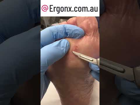 Painful Seed Corn Removal by Podiatrist: Relieve Foot Pain Fast! #Podiatry #FootCare