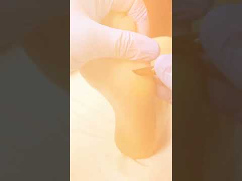 Got a pesky callus under your 5th toe? 😩 You’re not alone! Here’s a quick guide to getting rid of