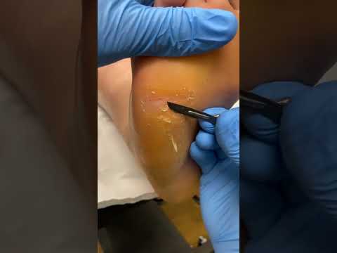 Satisfying Cracked Heel Transformation at the Podiatrist #FootCare #SatisfyingVideos