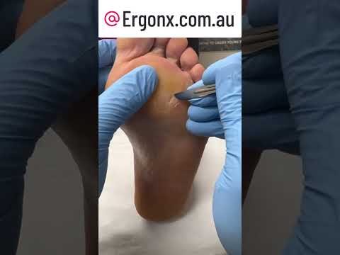 Ultimate Foot Transformation: Watch a Podiatrist Remove Thick Calluses & Corns #FootCare #Podiatry