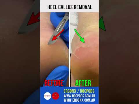 Podiatrist's Guide to Heel Callus Removal #CallusRemoval #FootCare