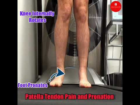 Feeling knee pain due to overpronation? 🌟 Discover the secrets to pain-free movement and healthier