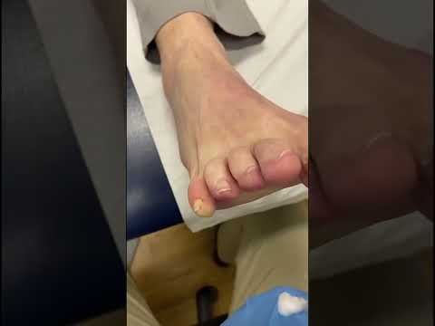 Have you ever seen an interdigital corn removal up close?😲 Watch closely as a skilled podiatrist