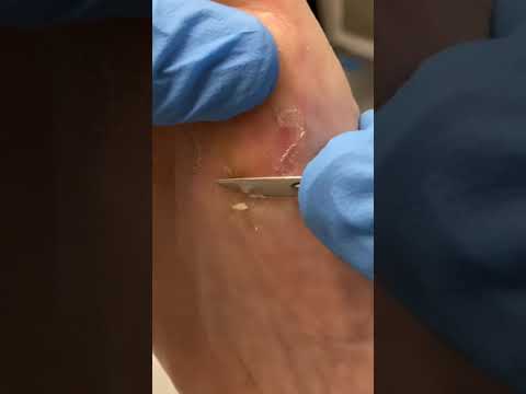 Transform your feet and step up your comfort game! Watch as a skilled podiatrist tackles bunions and