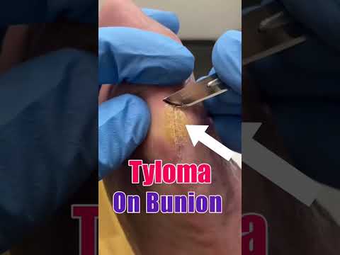 Watch this satisfying callus removal by a skilled podiatrist!👣 Say goodbye to foot discomfort and