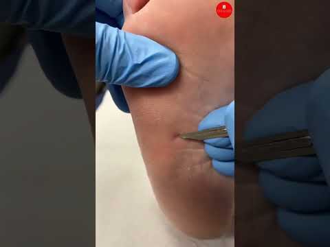 Severe Foot Corn Removal: What to Expect