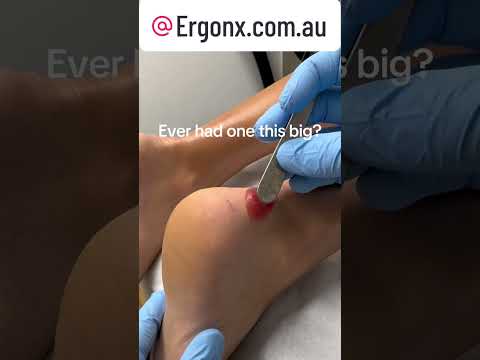 Half Marathon Madness: Gigantic Blood Blister Aftermath #RunningInjuries #HalfMarathon