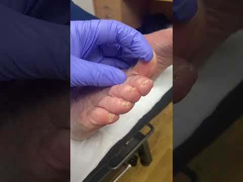 Watch this amazing transformation as a podiatrist removes a pesky corn from a big toe! Say goodbye