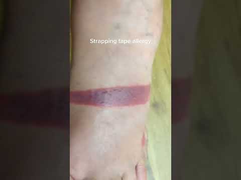 Experiencing a severe tape allergy and my foot is feeling the burn! 😫🔥 Anyone else dealt with this