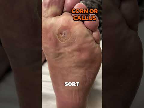 When we see thick callus and a corn under a plantar metatarsal head, it’s not “just hard skin.” It’s