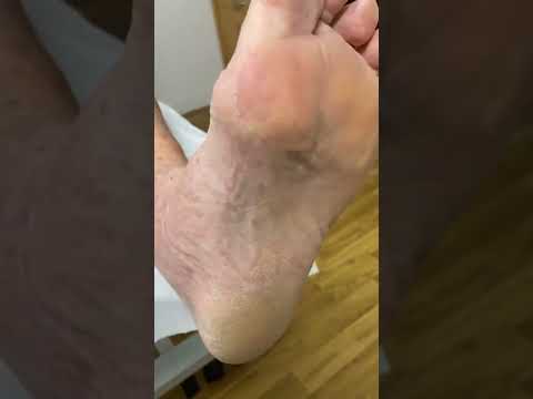 Watch me transform my feet from 'ouch' to 'wow'! 🚀👣 Wave goodbye to bunions, calluses, and hard