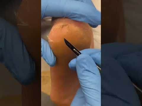 ✨ Watch the Satisfying Transformation: From Cracked Heels to Smooth Feet! 🚿👣 Dive into this