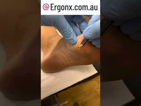 Satisfying Callus Removal: Watch a Podiatrist Work #FootCare #SatisfyingVideos