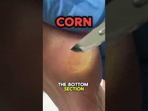 🔥 Painful Corn on a Hardworking Tradie’s Foot 🔥 This painful corn sits under the base of the fifth