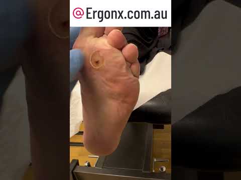 Aussie Podiatrist Removes Massive Corn & Callus | Satisfying Foot Care Transformation