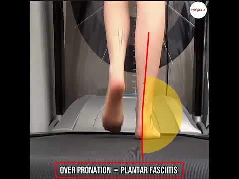 Understanding Overpronation and Plantar Fasciitis: Video Guide